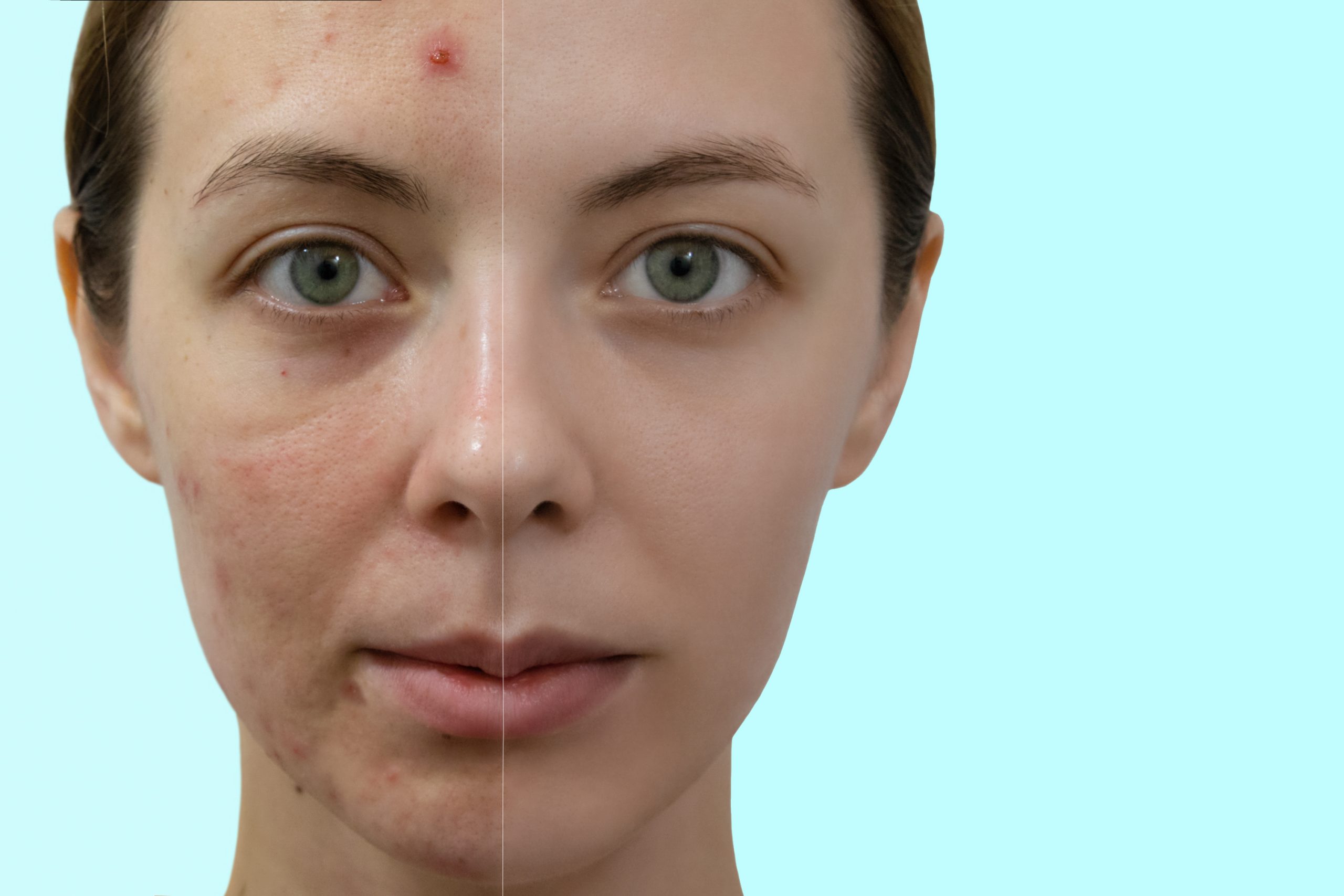 Comparison portrait of a woman with problematic skin without and with makeup.